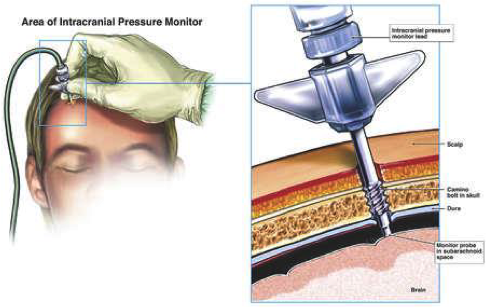 Intercranial pressure monitor infograph